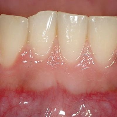 La santé de vos gencives est tout aussi importante que celle de vos dents. 