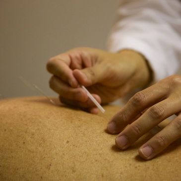 Kind Acupuncture Caring Holistic Medicine arthritis, allergies, acne,  chronic pain, sprains in DMV