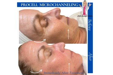 Microneedling 2024 Oklahoma City, Oklahoma