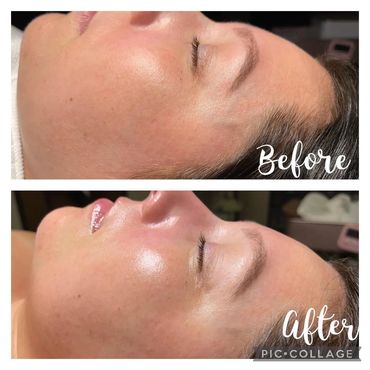 Dermaplaning facial