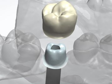 Custom Abutment Designs