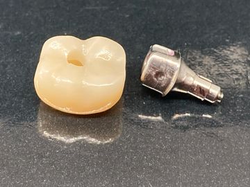 Screw Retained Crowns & Custom Cad Abutments