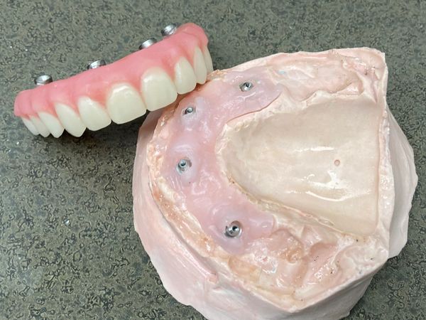 dental implant sample