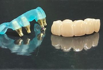 Cement Retained Implant Crown or Bridge