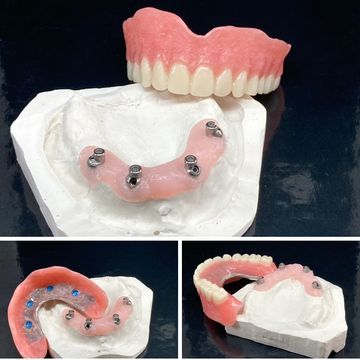 Custom angled Locator Denture