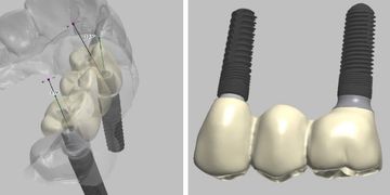 ASC Screw Retained Crown & Bridge