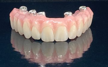 Hybrid Bar Denture