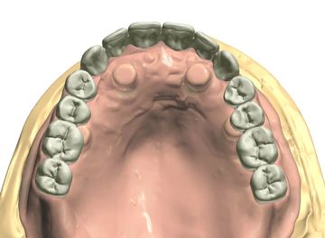 Implant Digital Dentures Designs