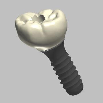 Custom Abutments with Crown Designs
