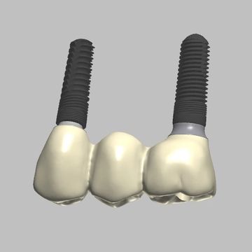 Custom Implant Bridge Designs