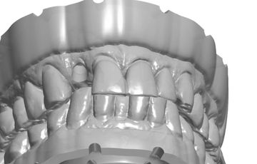 Model: Implant with soft tissue