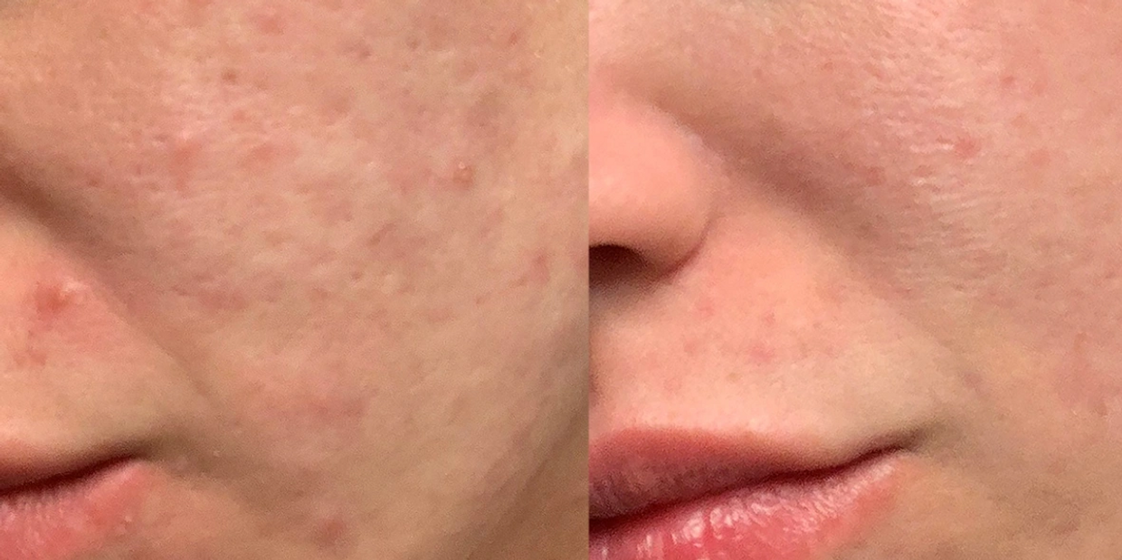 Rf Microneedling, skin rejuvenation, Exosomes, anti-aging, Dr. Melissa Blackburn, Morpheus, IPL