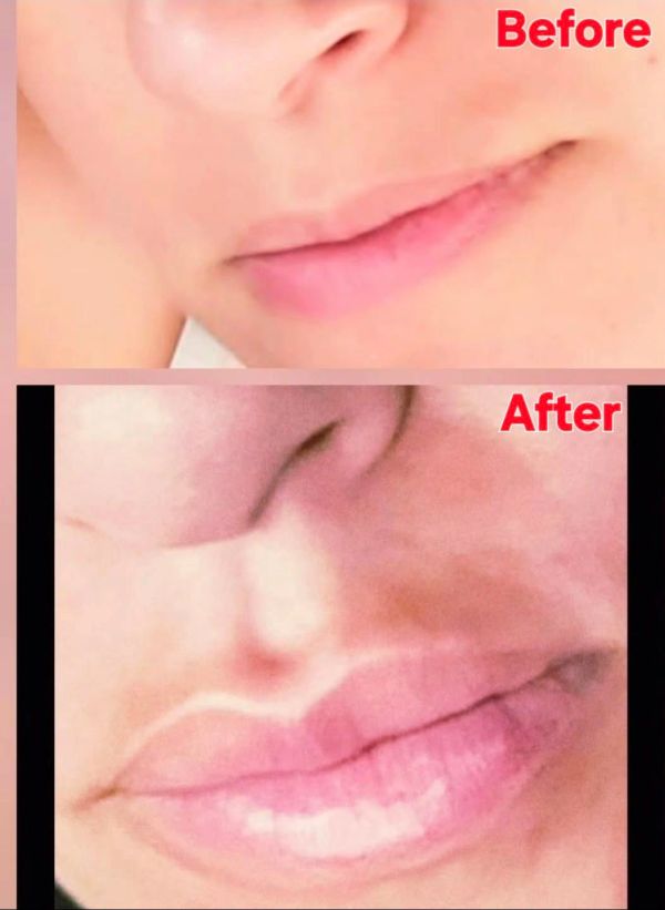 Comparison of lips before and after treatment or enhancement.