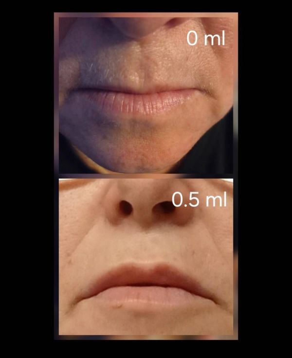 Before and after lip treatment showing volume increase.