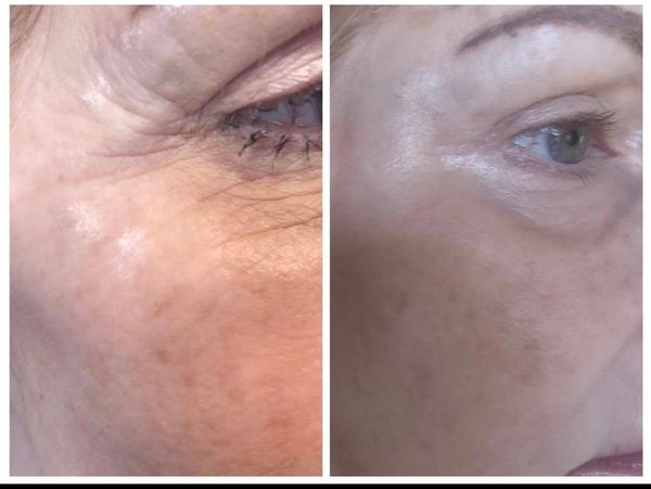 Before and after skin improvement around the eye area.