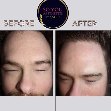 Smooth skin after transformation from dermaplaning, no wrinkles 