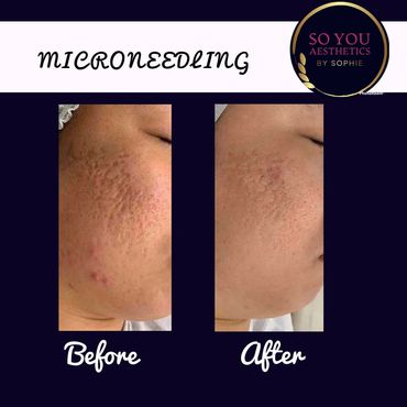 Microneedling pores 