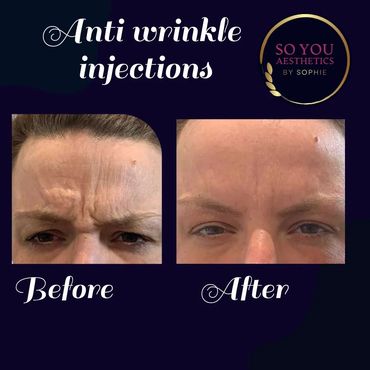 Smooth, wrinkle free skin after anti wrinkle Botox treatment 