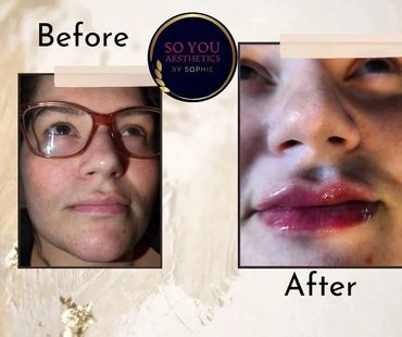 Transformation after lip filler, pouty lips, dermal filler 