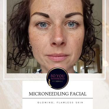 Smooth glowing skin after microneedling facial, reduced pores, pigmentation 