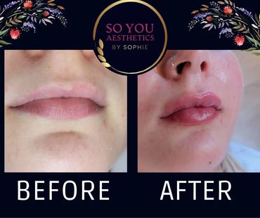 Enhanced lips after dermal filler 