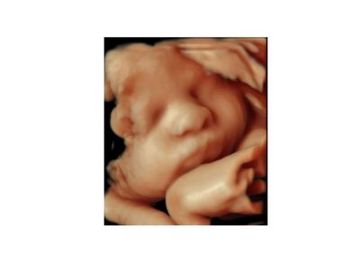 3D ultrasound image of a fetus in the womb.