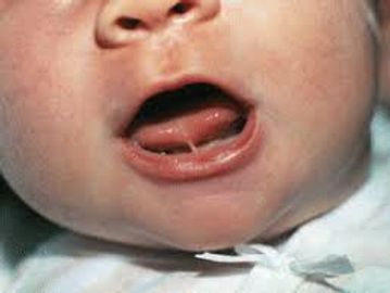 baby with tongue-tie (frenulotomy)
