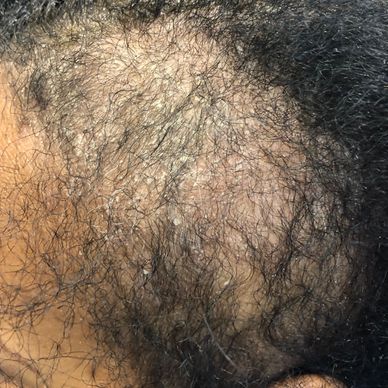 Image of Hormonal Hair Loss