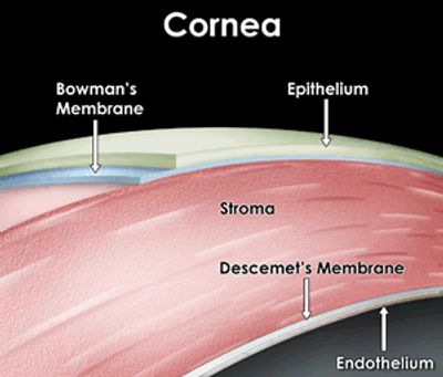 Cornea transplant explained.