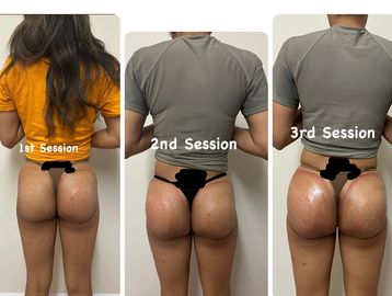 Battle of the Butt Lifts: Is Brazilian or Sculptra Best for You