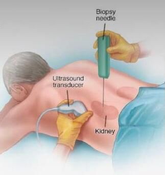 renal biopsy needle