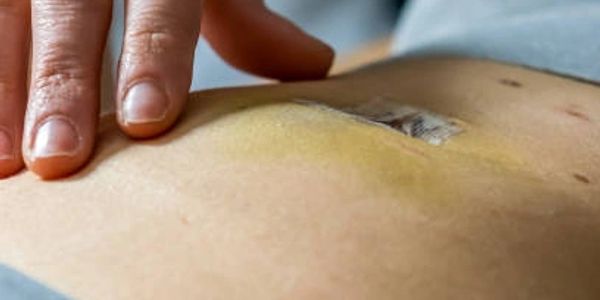 surgical scar
