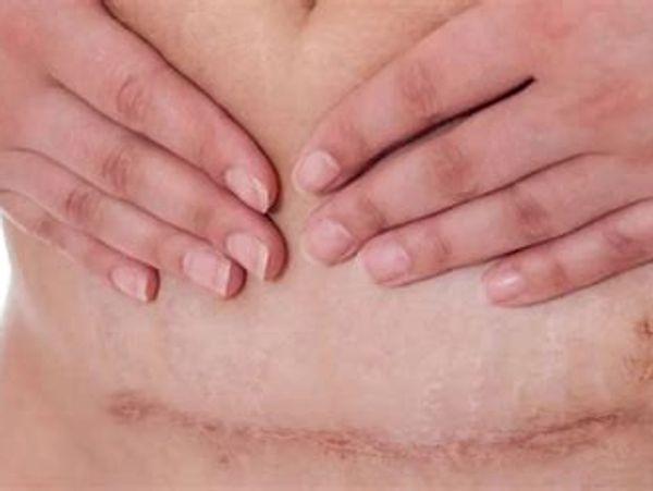 Person holding hands over a healed surgical scar on the abdomen.