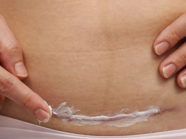 Close-up of hands applying cream on skin near a scar.