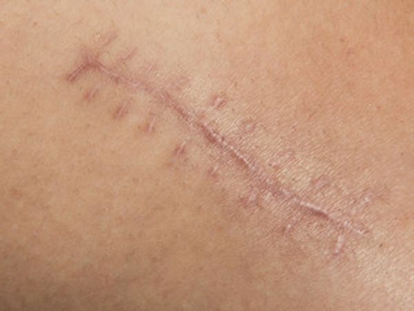Scar with suture marks on skin.
