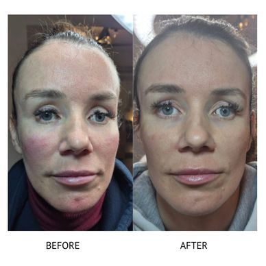 Temple filler dermal filler look younger anti aging aesthetics nurse Newtownards 
