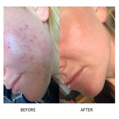 Chemical peel for acne nurse led aesthetics Newtownards Belfast portaferry