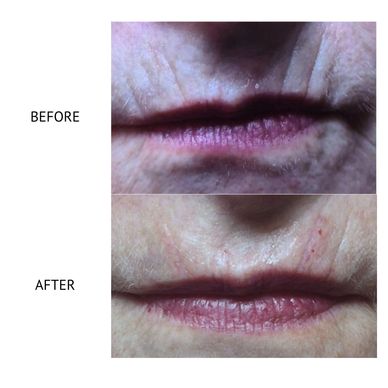 Dermal filler smokers lines