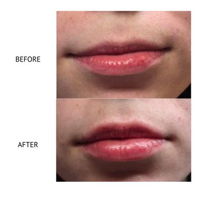 Lip filler Newtownards lip filler county down