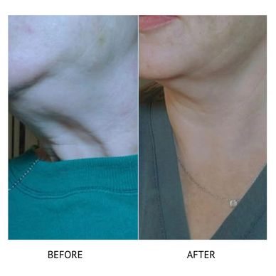 Jowl lift Newtownards neck lift Botox Newtownards anti aging treatments 