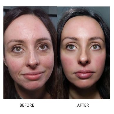 Chemical peels help acne even skin tone Newtownards chemical peel 