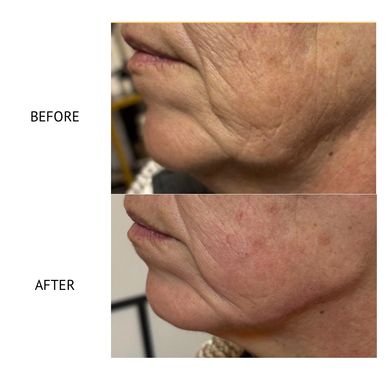 Jawline contouring Newtownards 