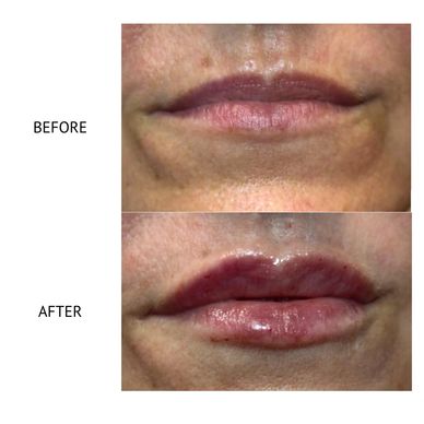 Lip filler Newtownards 