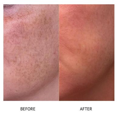 Botox Newtownards Botox near me Best Botox clinic newtownards 