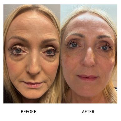 Before and after filler 