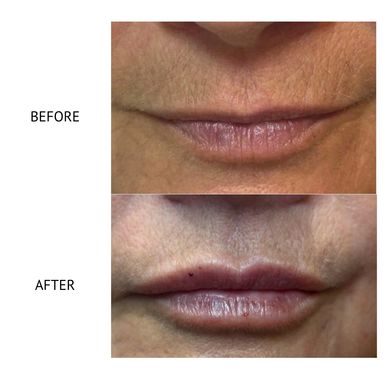 Lip filler Newtownards 