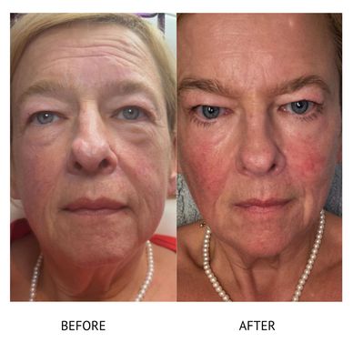 Botox Newtownards Botox and fill