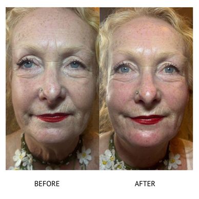 Filler Newtownards Botox Newtownards 