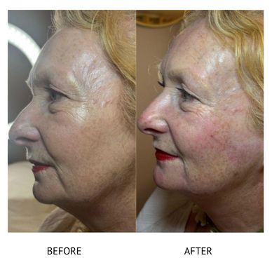 Fillers Newtownards Botox Newtownards