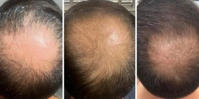 hair restoration underway on man due to balding or alopecia